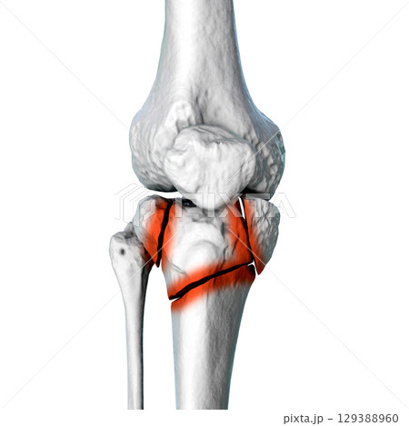Tibia fracture Schatzker type VI, 3D illustration 129388960