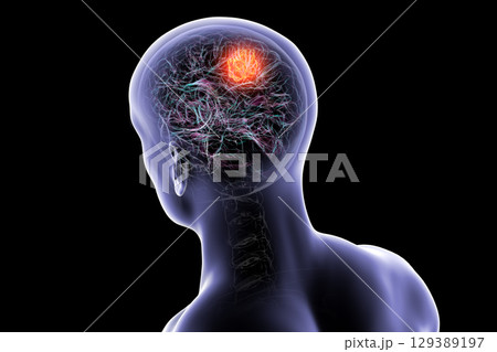 Brain tumor, 3D illustration Brain tumor, 3D illustration 129389197
