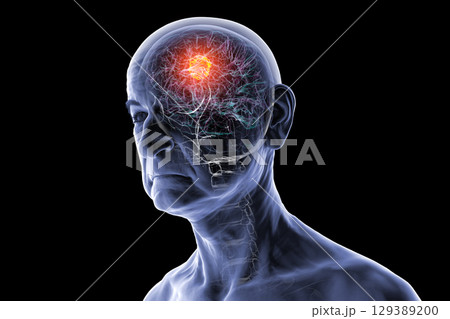 Brain tumor, 3D illustration 129389200