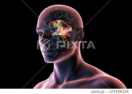 A brain tumor causing hydrocephalus, 3D illustration 129389226