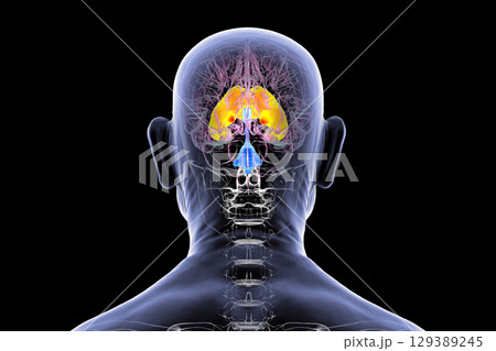 Enlarged lateral ventricles of the brain, 3D illustration Enlarged lateral ventricles of the brain, 3D illustration 129389245