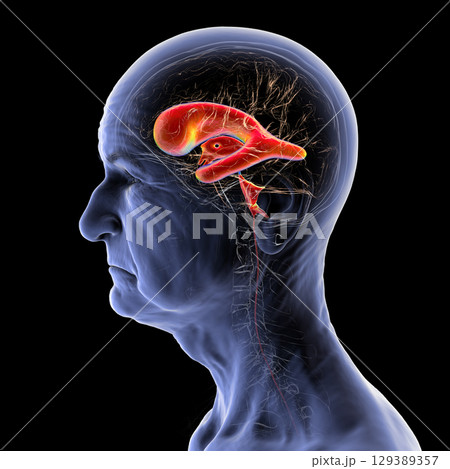 Normal pressure hydrocephalus, 3D illustration Normal pressure hydrocephalus, 3D illustration 129389357