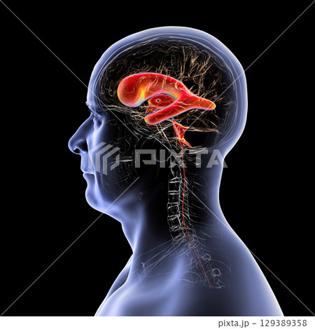Normal pressure hydrocephalus, 3D illustration 129389358