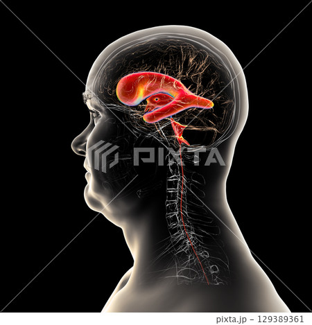 Normal pressure hydrocephalus, 3D illustration 129389361