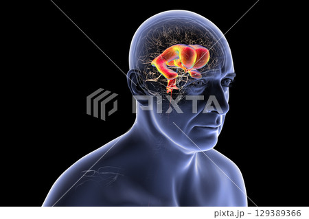 Normal pressure hydrocephalus, 3D illustration Normal pressure hydrocephalus, 3D illustration 129389366
