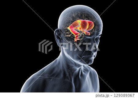 Normal pressure hydrocephalus, 3D illustration Normal pressure hydrocephalus, 3D illustration 129389367