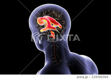 Normal pressure hydrocephalus, 3D illustration Normal pressure hydrocephalus, 3D illustration 129389368