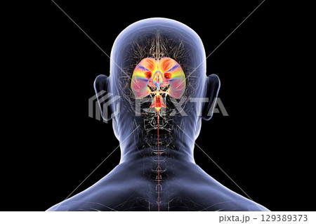 Normal pressure hydrocephalus, 3D illustration Normal pressure hydrocephalus, 3D illustration 129389373