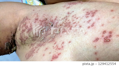 Close-Up of Herpes Skin Outbreak in woman's Armpit Area Close-Up of Herpes Skin Outbreak in woman's Armpit Area 129412554