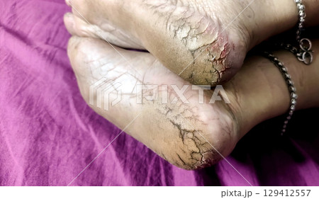 Close-Up of Cracked Heels and Bare Feet 129412557