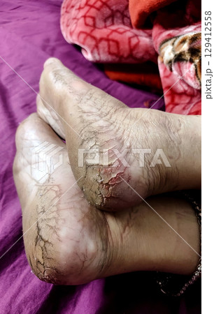 Close-Up of Cracked Heels and Bare Feet 129412558
