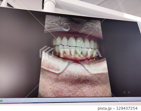 Dental tooth implantation. Dental surgeon inserts the body of the implant into the jaw bone in modern dental clinic. Dental surgery 129437254