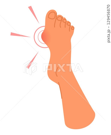 Foot of person with enlarged joint of big toe. Irregular deformity. Pain at bunion. Barefoot human leg. Orthopedic disease. Painful sole joint. Suffer from arthritis. Vector concept 129456870
