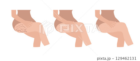 Woman checking stretch marks on her legs, showing different stages of healing 129462131