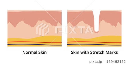 Normal skin versus skin with stretch marks 129462132