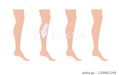 Hair removal cream being applied on hairy legs 129462148