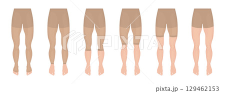 Compression garments showing different levels of pressure for medical purposes 129462153