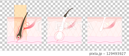 How hair falls out after medical hair removal or laser hair removal How hair falls out after medical hair removal or laser hair removal 129493927