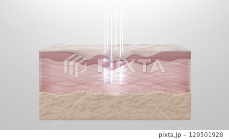 肌再生治療のCGイラスト素材 真皮層のコラーゲンを活性化させるレーザー施術 129501928