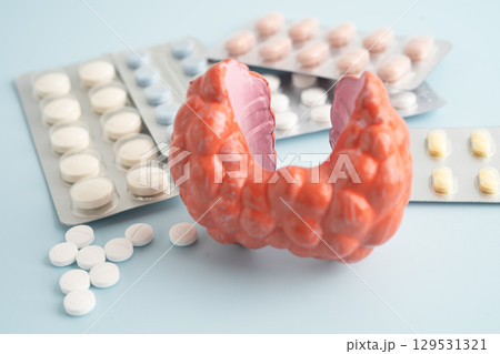 Thyroid model with pill drug treatment, Hyperthyroidism, Overactive or Lymphoma. Thyroid model with pill drug treatment, Hyperthyroidism, Overactive or Lymphoma. 129531321