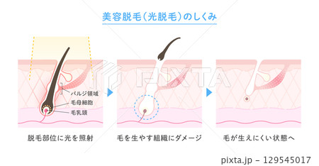脱毛のイメージ、美容脱毛・光脱毛のしくみのイラスト 129545017