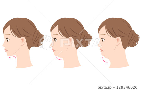 二重あごとスッキリしたあご　ビフォーアフター 129546620