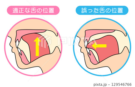 正しいミューイングの方法 適正な舌の位置と誤った舌の位置 正しいミューイングの方法 適正な舌の位置と誤った舌の位置 129546766