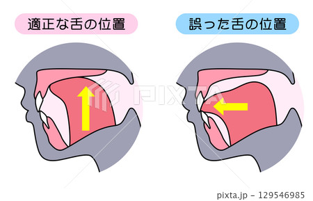 正しいミューイングの方法　適正な舌の位置と誤った舌の位置 129546985