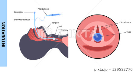 Intubation medical procedure 129552770