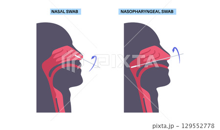 Nasopharyngeal and nasal swab Nasopharyngeal and nasal swab 129552778