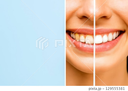 Before and after teeth whitening comparison. concept of dental care, oral hygiene, cosmetic dentistry and professional whitening. Before and after teeth whitening comparison. concept of dental care, oral hygiene, cosmetic dentistry and professional whitening. 129555381