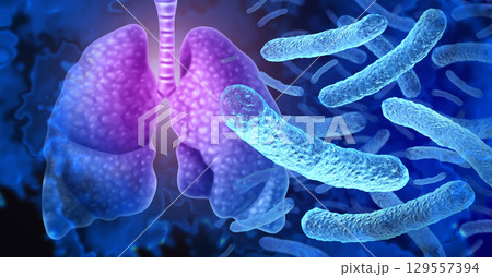 Legionnaires Disease 129557394