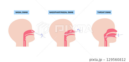 swab medical procedure swab medical procedure 129560812