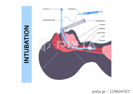 Intubation medical procedure Intubation medical procedure 129604707
