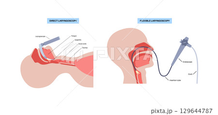 Laryngoscopy medical procedure 129644787