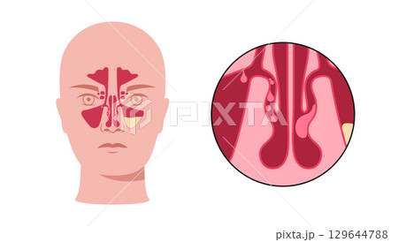 Nasal polyps poster 129644788