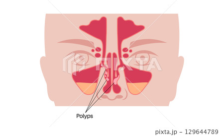 Nasal polyps poster 129644789