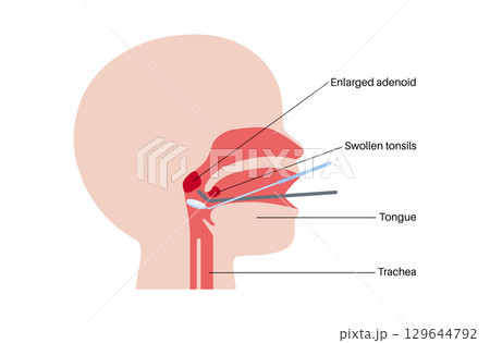 Adenoidectomy medical procedure Adenoidectomy medical procedure 129644792