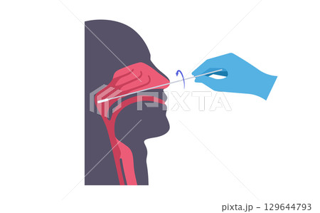 Nasopharyngeal swab procedure Nasopharyngeal swab procedure 129644793