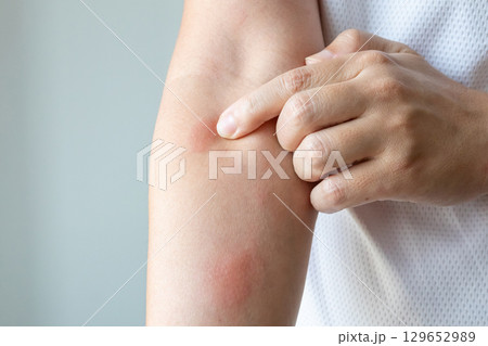 Young asian man itching and scratching on arm from allergic itchy dry skin eczema dermatitis insect bites Young asian man itching and scratching on arm from allergic itchy dry skin eczema dermatitis insect bites 129652989