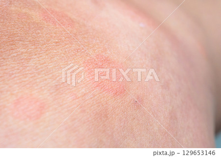 Young asian man has allergic skin rash on his legs from itchy dry skin eczema dermatitis insect bites Young asian man has allergic skin rash on his legs from itchy dry skin eczema dermatitis insect bites 129653146