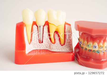 Dental implant, artificial tooth roots into jaw, root canal of dental treatment, gum disease, teeth model for dentist studying about dentistry. Dental implant, artificial tooth roots into jaw, root canal of dental treatment, gum disease, teeth model for dentist studying about dentistry. 129657272