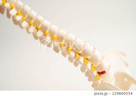 Spinal nerve and bone, Lumbar spine displaced herniated disc fragment, Model for treatment medical in the orthopedic department. 129660554