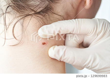 Medical examination of skin mole on caucasian female neck by gloved hands 129699983
