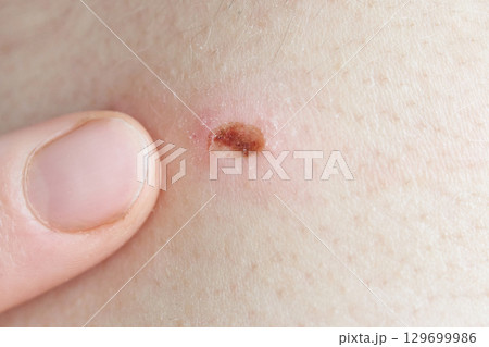 Close-up of a healing skin wound with scab formation Close-up of a healing skin wound with scab formation 129699986