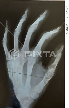 X-ray of the left hand brush for medical examination 129724759