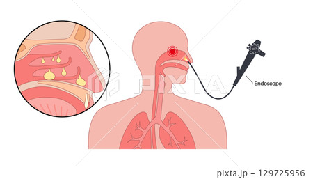 Nasal endoscopy poster 129725956