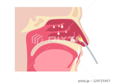 Nasal endoscopy poster 129725957