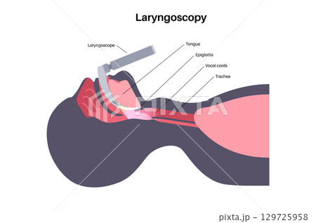 Laryngoscopy medical procedure 129725958