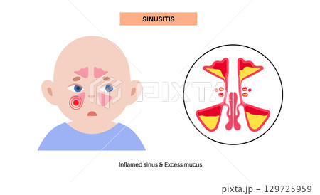 Sinusitis medical poster 129725959